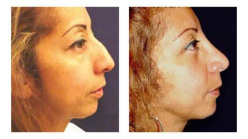 Facial-Surgery-16 Before-After Dr-Michael-Jones