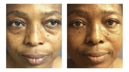 Facial-Surgery-1 Before-After Dr-Abel-Giorgis