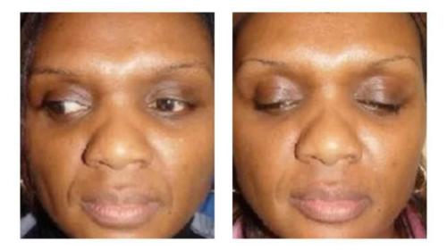 Facial-Surgery-2 Before-After Dr-Michael-Jones