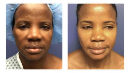 Facial-Surgery-3 Before-After Dr-Michael-Jones