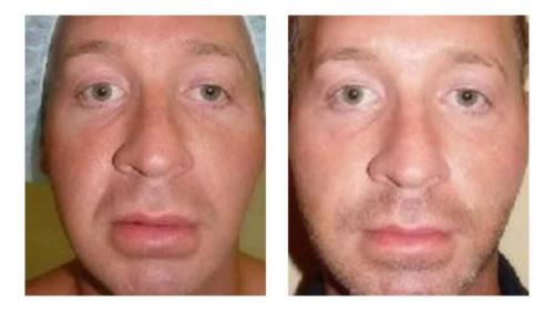 Facial-Surgery-4 Before-After Dr-Michael-Jones