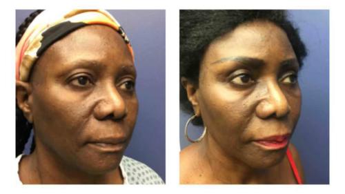 Facial-Surgery-5 Before-After Dr-Michael-Jones