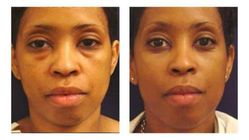 Facial-Surgery-6 Before-After Dr-Michael-Jones