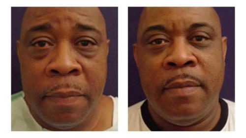 Facial-Surgery-8 Before-After Dr-Michael-Jones