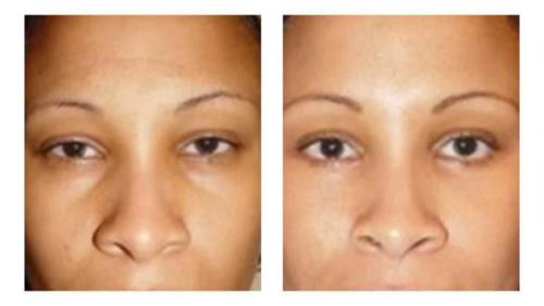 Facial-Surgery-9 Before-After Dr-Michael-Jones