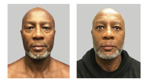 Facial-Surgery-Blepharoplasty-1 Before-After Dr-Nicholas-Jones