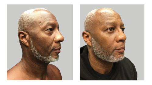 Facial-Surgery-Blepharoplasty-2 Before-After Dr-Nicholas-Jones
