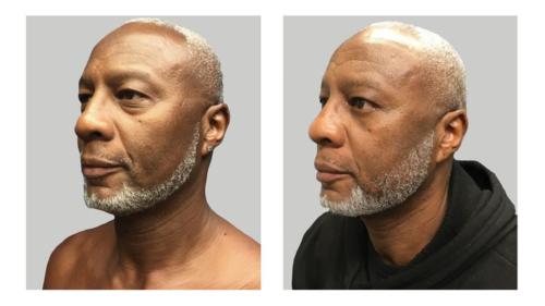 Facial-Surgery-Blepharoplasty-3 Before-After Dr-Nicholas-Jones