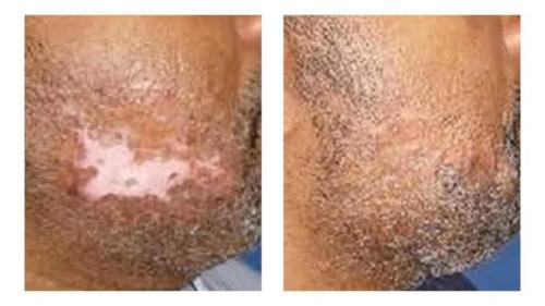 Keloids-Men-11 Before-After Dr-Michael-Jones