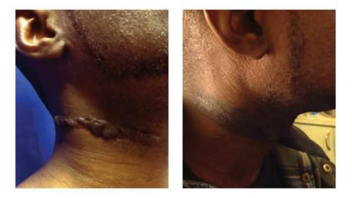 Keloids-Men-18 Before-After Dr-Michael-Jones