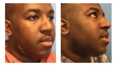 Keloids-Men-3 Before-After Dr-Nicholas-Jones