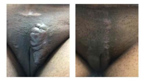 Keloids-Women-10 Before-After Dr-Michael-Jones