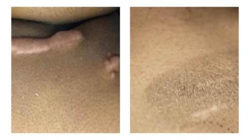 Keloids-Women-13 Before-After Dr-Michael-Jones