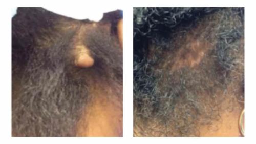 Keloids-Women-14 Before-After Dr-Michael-Jones