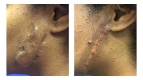 Keloids-Women-15 Before-After Dr-Michael-Jones