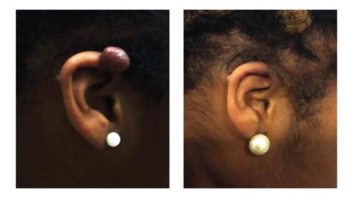 Keloids-Women-16 Before-After Dr-Michael-Jones