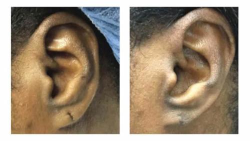 Keloids-Women-20 Before-After Dr-Michael-Jones