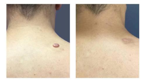 Keloids-Women-24 Before-After Dr-Michael-Jones