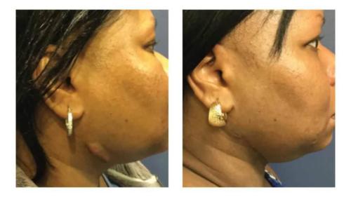 Keloids-Women-5 Before-After Dr-Michael-Jones