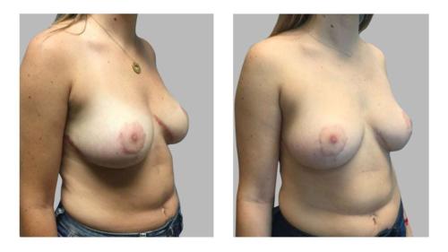 Keloids-Women-Breast-2 Before-After Dr-Frederick-T-Work