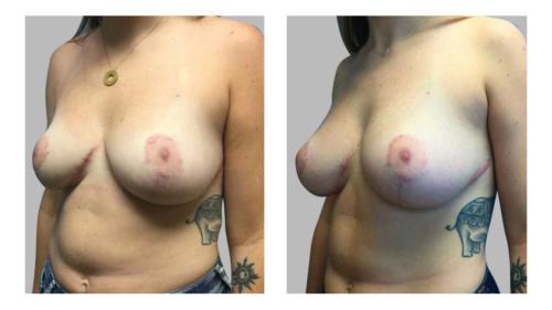 Keloids-Women-Breast-3 Before-After Dr-Frederick-T-Work