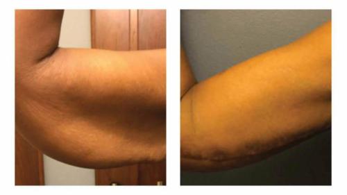 Liposuction-1 Before-After Dr-Gerald-Ginsberg