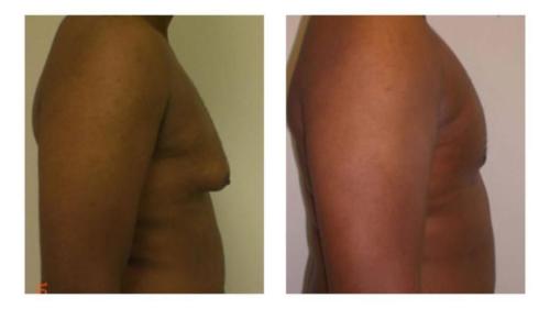 Men-4 Before-After Dr-Michael-Jones