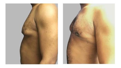 Men-Gynecomastia-1 Before-After Dr-Abel-Giorgis