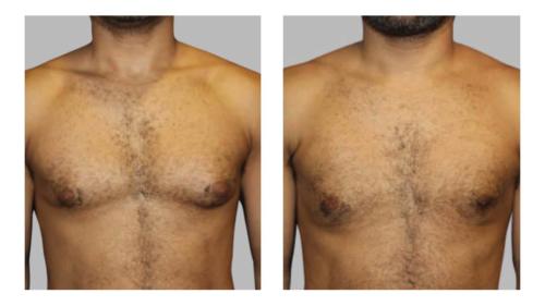 Men-Gynecomastia-1 Before-After Dr-Charlie-Chen