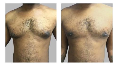 Men-Gynecomastia-2 Before-After Dr-Abel-Giorgis