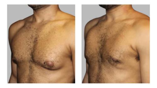 Men-Gynecomastia-2 Before-After Dr-Charlie-Chen