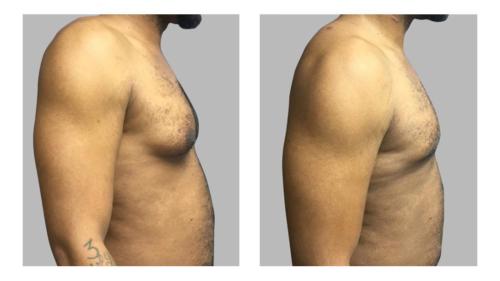 Men-Gynecomastia-3 Before-After Dr-Abel-Giorgis