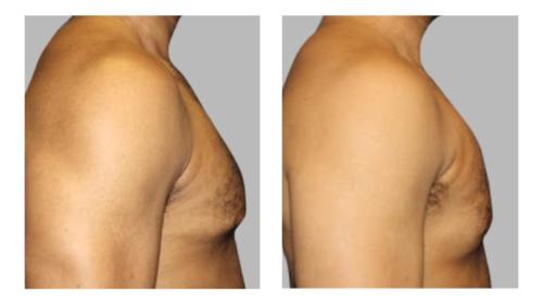 Men-Gynecomastia-3 Before-After Dr-Charlie-Chen