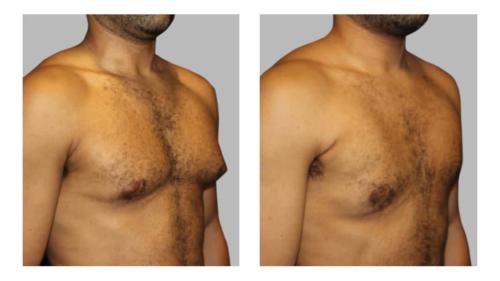 Men-Gynecomastia-4 Before-After Dr-Charlie-Chen