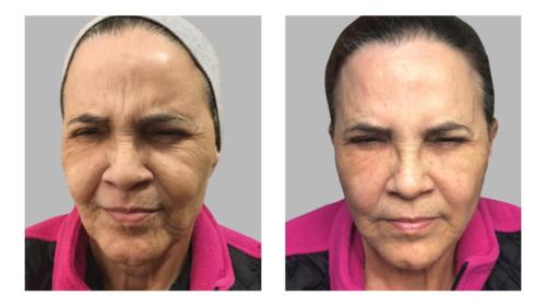 Non-Surgical-Botox-1 Before-After Dr-Charlie-Chen