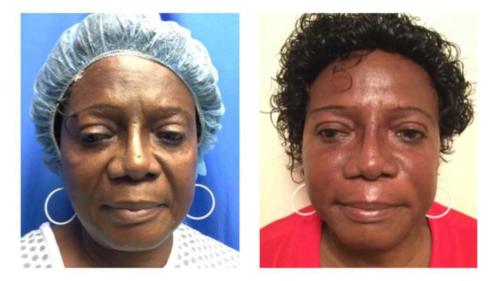 Non-Surgical-Facial-1 Before-After Dr-Gerald-Ginsberg