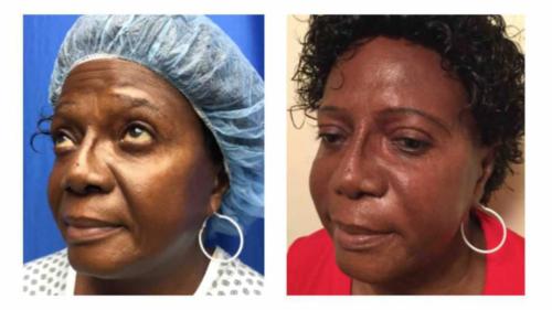 Non-Surgical-Facial-2 Before-After Dr-Gerald-Ginsberg