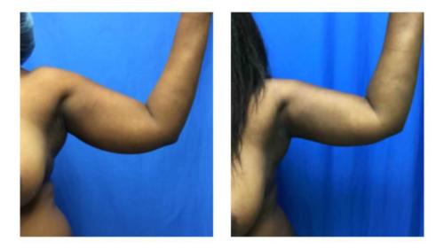 Tummy-Tuck-Liposuction-10 Before-After Dr-Michael-Jones