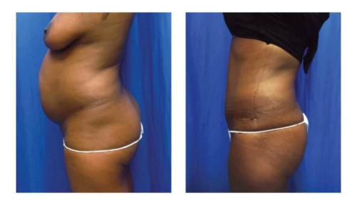 Tummy-Tuck-Liposuction-11 Before-After Dr-Michael-Jones