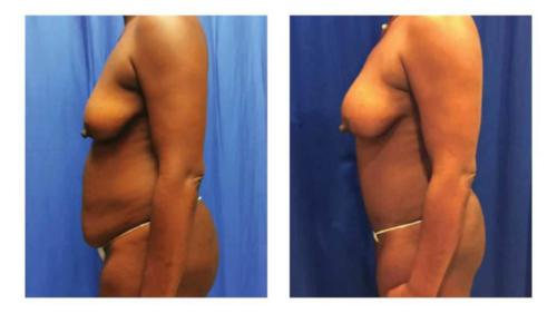 Tummy-Tuck-Liposuction-12 Before-After Dr-Michael-Jones