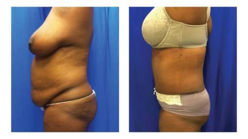 Tummy-Tuck-Liposuction-13 Before-After Dr-Michael-Jones