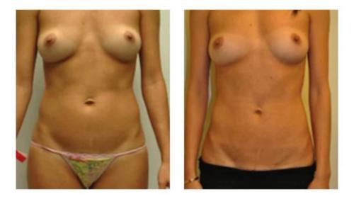 Tummy-Tuck-Liposuction-14 Before-After Dr-Michael-Jones