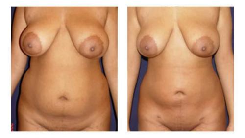 Tummy-Tuck-Liposuction-15 Before-After Dr-Michael-Jones