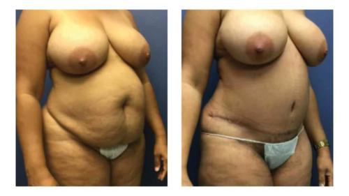 Tummy-Tuck-Liposuction-16 Before-After Dr-Michael-Jones