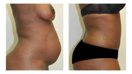 Tummy-Tuck-Liposuction-17 Before-After Dr-Michael-Jones