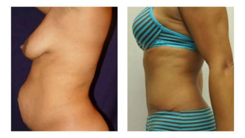 Tummy-Tuck-Liposuction-18 Before-After Dr-Michael-Jones