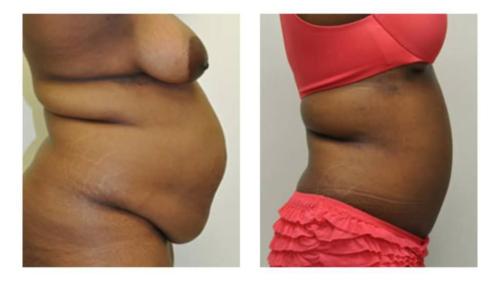 Tummy-Tuck-Liposuction-19 Before-After Dr-Michael-Jones