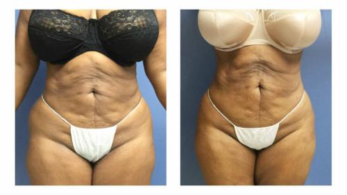 Tummy-Tuck-Liposuction-1 Before-After Dr-Abel-Giorgis
