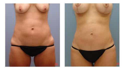 Tummy-Tuck-Liposuction-1 Before-After Dr-Charlie-Chen