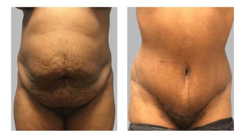 Tummy-Tuck-Liposuction-1 Before-After Dr-Frederick-T-Work